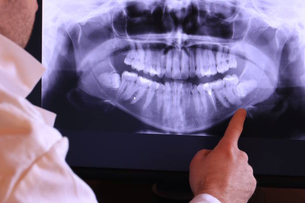 Best Emergency Wisdom Tooth Extraction in Redmond, WA